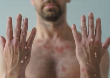 A varíola dos macacos atinge cerca de 2 mil pessoas no Brasil