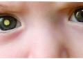Retinoblastoma: se liga no olhar do seu filho