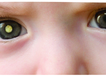Retinoblastoma: se liga no olhar do seu filho