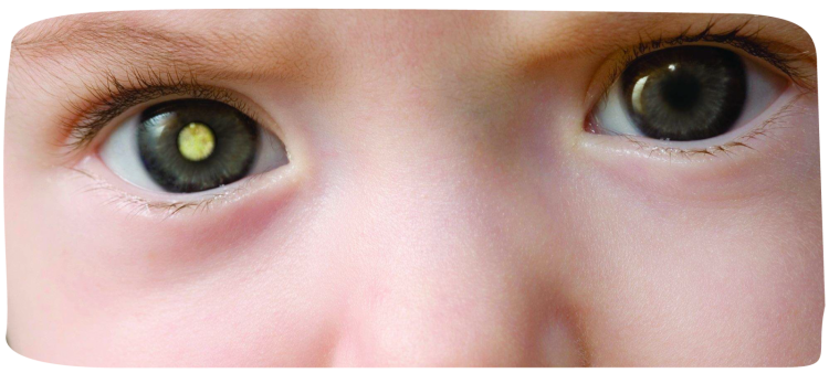Retinoblastoma: se liga no olhar do seu filho