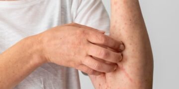 Mpox: prevenção e cuidados essenciais